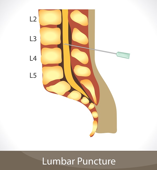 Cauda Equina Syndrome after a Lumbar Puncture